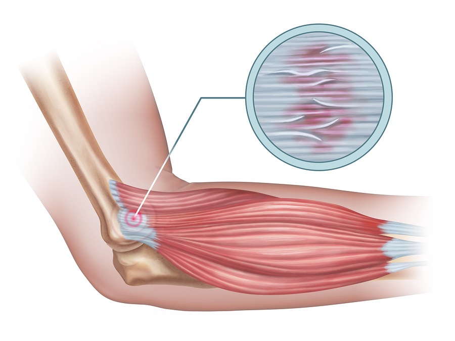 Tennis elbow diagram showing a detail of the damaged tendon tissue